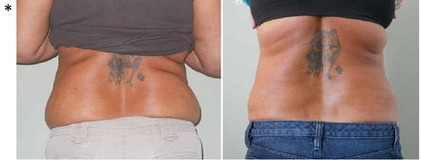 weight loss example: before and after photos: Slender Body Solutions